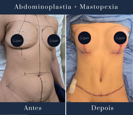 Abdominoplastia - Clinica San Martin
